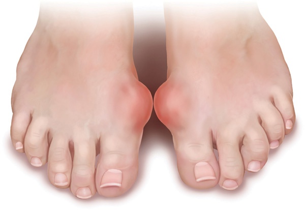 Gout