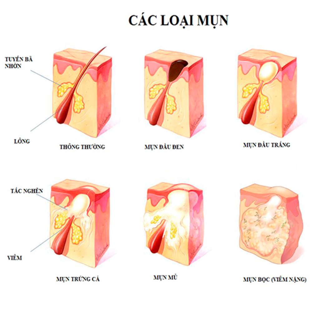 Lỗ chân lông to